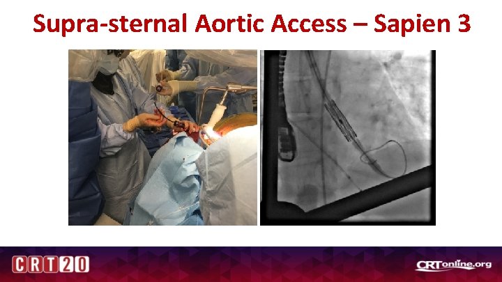 Supra-sternal Aortic Access – Sapien 3 