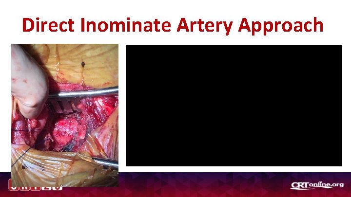 Direct Inominate Artery Approach 