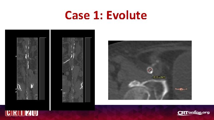 Case 1: Evolute 