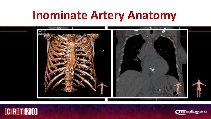 Inominate Artery Anatomy 