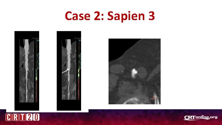 Case 2: Sapien 3 