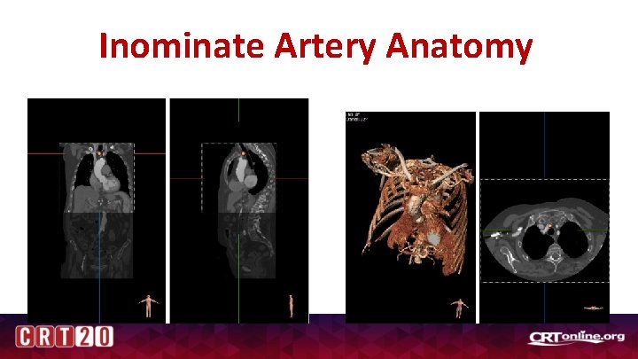 Inominate Artery Anatomy 