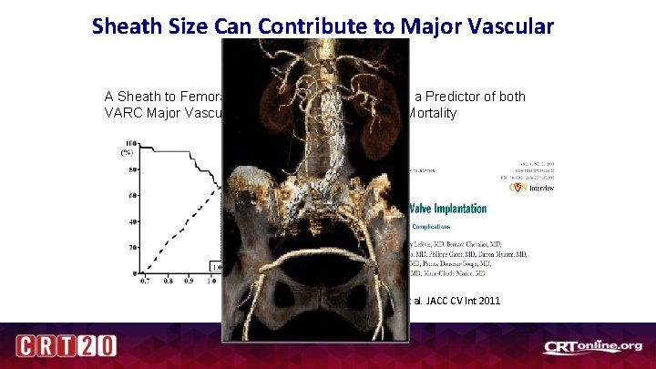 Sheath Size Can Contribute to Major Vascular Complications A Sheath to Femoral Artery Ratio
