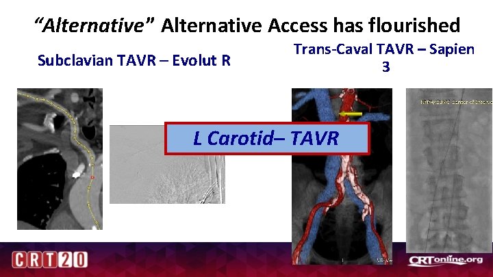 “Alternative” Alternative Access has flourished Subclavian TAVR – Evolut R Trans-Caval TAVR – Sapien