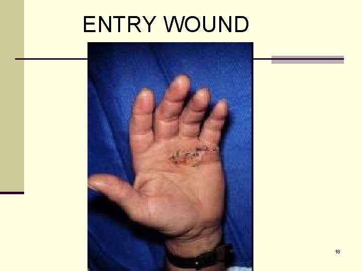 ENTRY WOUND 18 