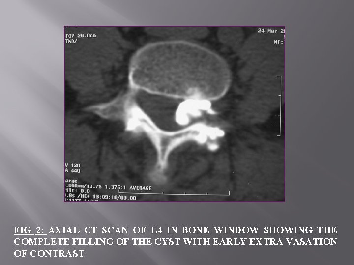 FIG 2: AXIAL CT SCAN OF L 4 IN BONE WINDOW SHOWING THE COMPLETE