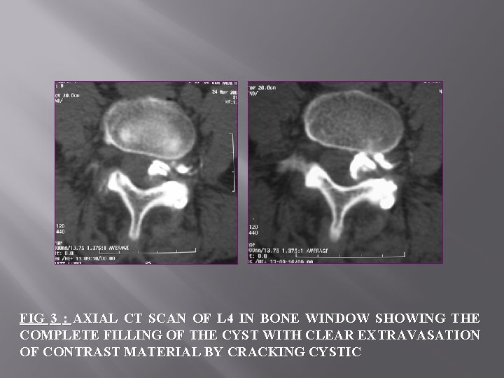 FIG 3 : AXIAL CT SCAN OF L 4 IN BONE WINDOW SHOWING THE