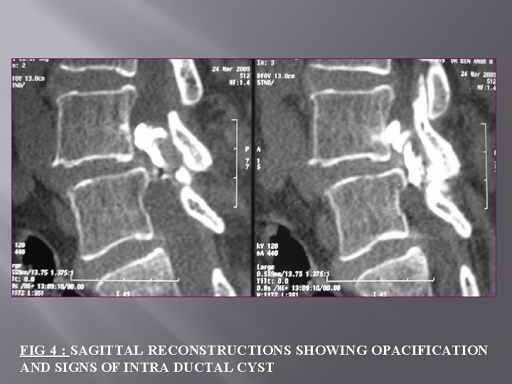 FIG 4 : SAGITTAL RECONSTRUCTIONS SHOWING OPACIFICATION AND SIGNS OF INTRA DUCTAL CYST 