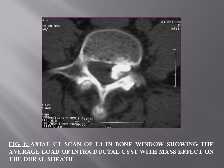 FIG 1: AXIAL CT SCAN OF L 4 IN BONE WINDOW SHOWING THE AVERAGE