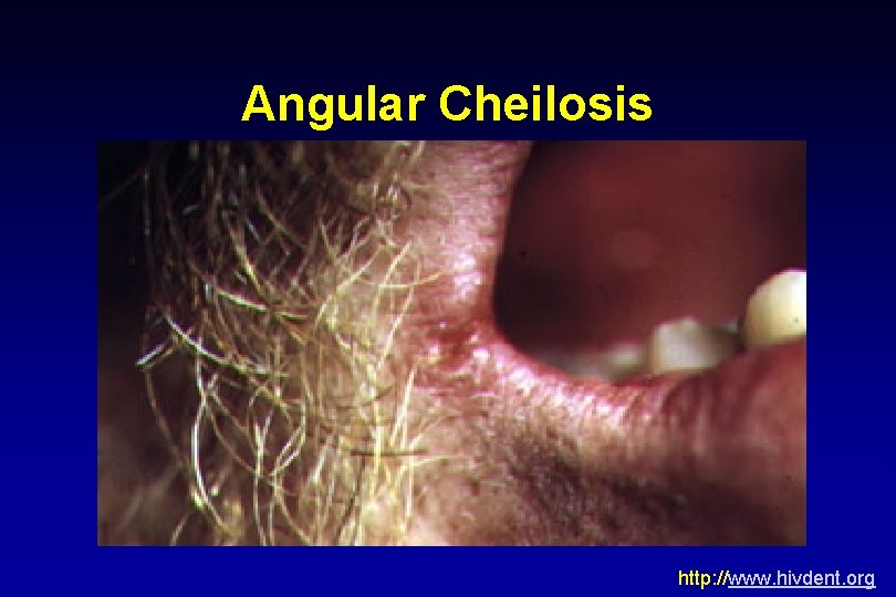 Angular Cheilosis • http: //www. hivdent. org 