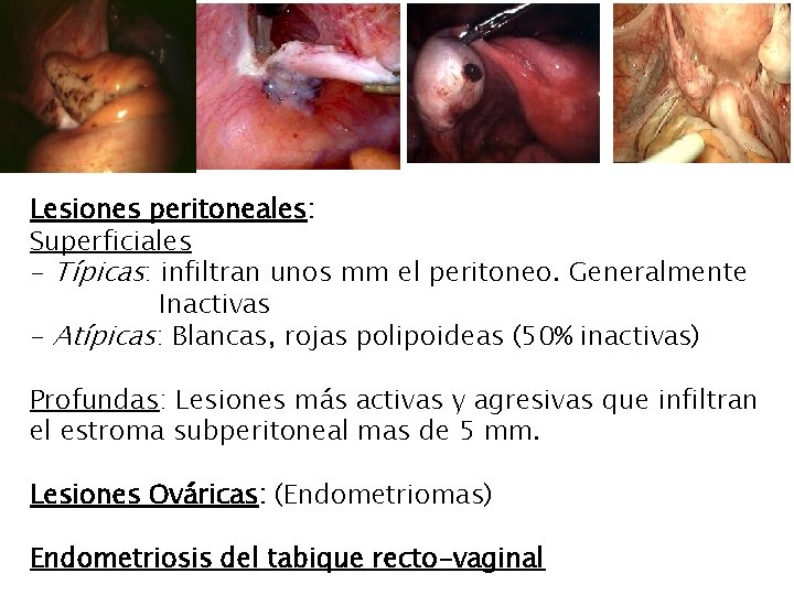 Lesiones peritoneales: Superficiales - Típicas: infiltran unos mm el peritoneo. Generalmente Inactivas - Atípicas: