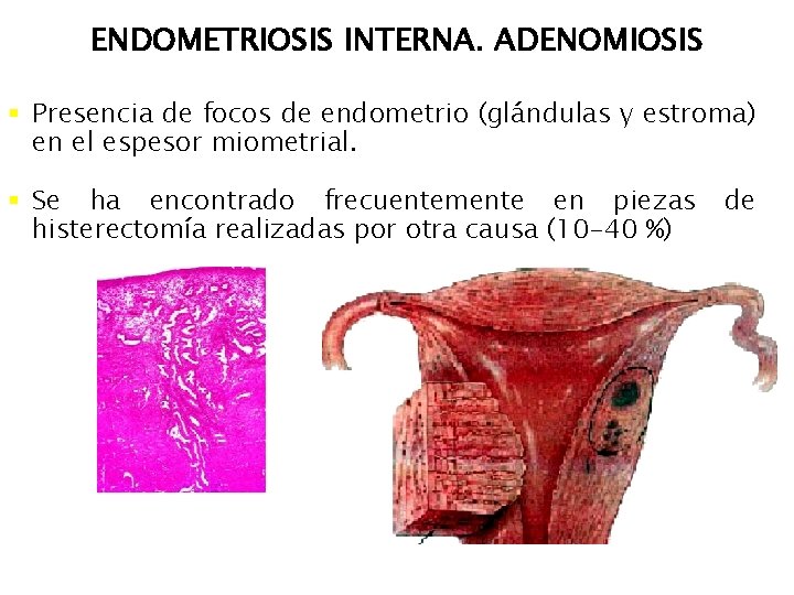 ENDOMETRIOSIS INTERNA. ADENOMIOSIS § Presencia de focos de endometrio (glándulas y estroma) en el