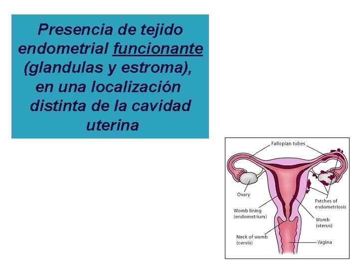 Presencia de tejido endometrial funcionante (glandulas y estroma), en una localización distinta de la