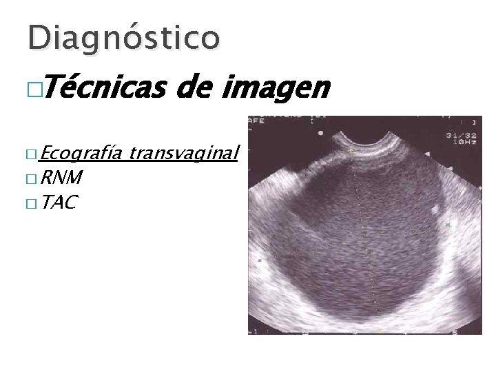 Diagnóstico �Técnicas de imagen � Ecografía � RNM � TAC transvaginal 