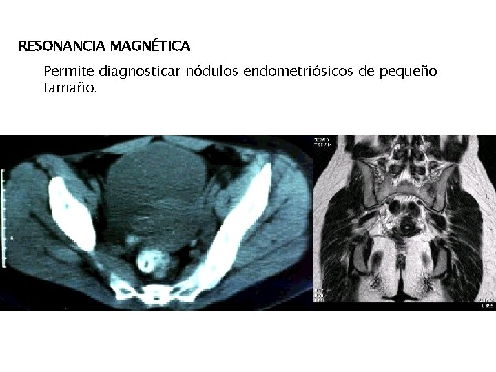 RESONANCIA MAGNÉTICA Permite diagnosticar nódulos endometriósicos de pequeño tamaño. 