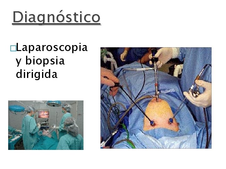 Diagnóstico �Laparoscopia y biopsia dirigida 