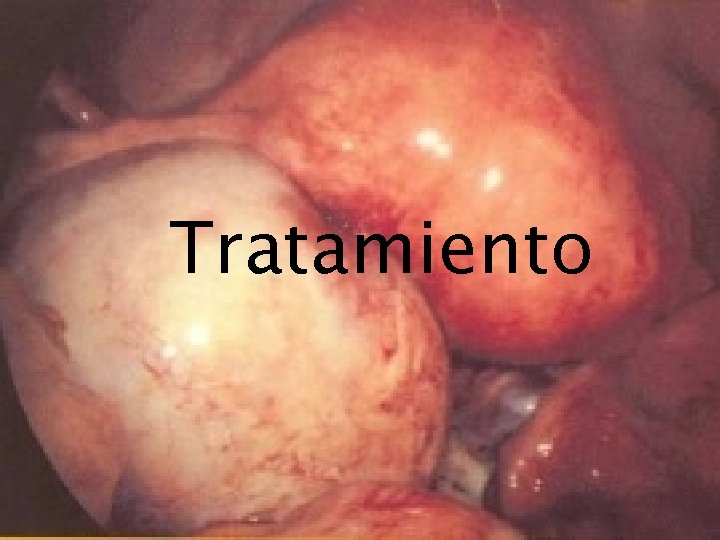 Tratamiento TRATAMIENTO 