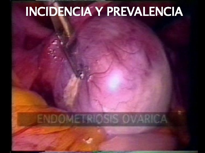 INCIDENCIA Y PREVALENCIA 