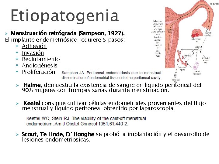 Etiopatogenia Menstruación retrógrada (Sampson, 1927). El implante endometriósico requiere 5 pasos: Adhesión Invasión Reclutamiento