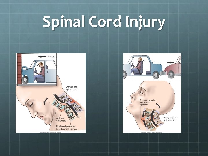 Spinal Cord Injury 