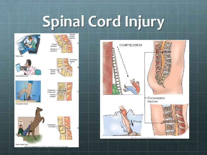 Spinal Cord Injury 