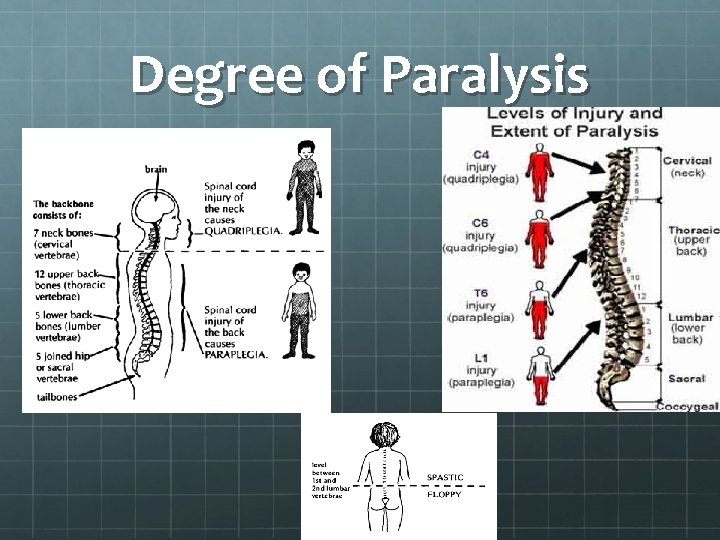 Degree of Paralysis 