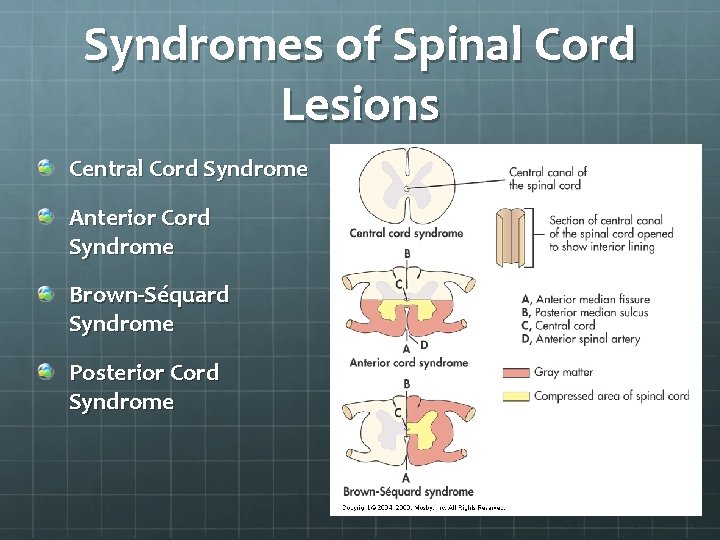 Syndromes of Spinal Cord Lesions Central Cord Syndrome Anterior Cord Syndrome Brown-Séquard Syndrome Posterior