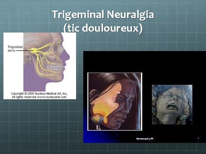 Trigeminal Neuralgia (tic douloureux) 