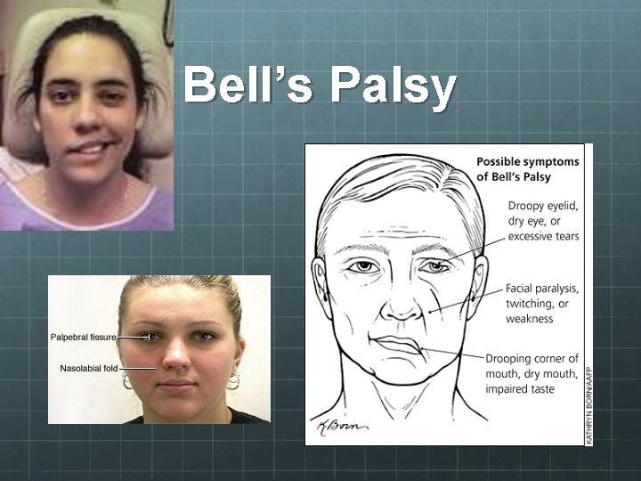 Bell’s Palsy 