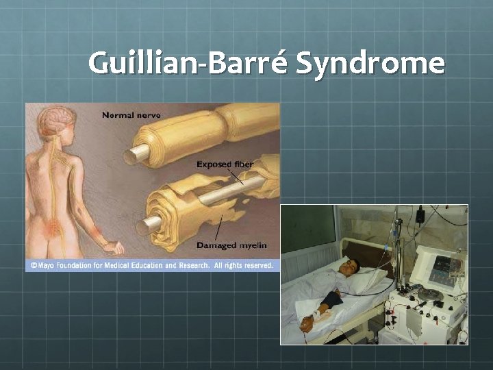Guillian-Barré Syndrome 