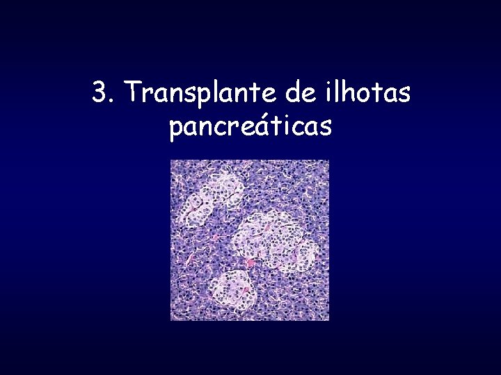 3. Transplante de ilhotas pancreáticas 