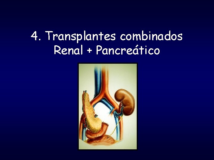 4. Transplantes combinados Renal + Pancreático 