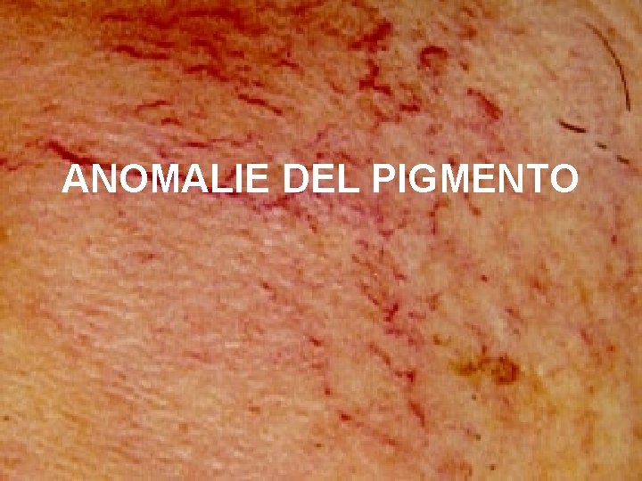 ANOMALIE DEL PIGMENTO 