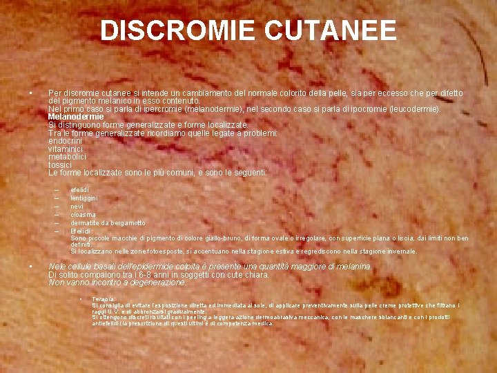 DISCROMIE CUTANEE • Per discromie cutanee si intende un cambiamento del normale colorito della