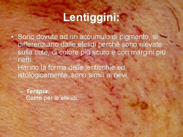 Lentiggini: • Sono dovute ad un accumulo di pigmento, si differenziano dalle efelidi perchè