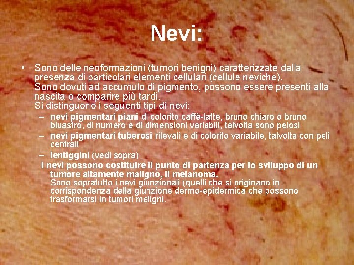 Nevi: • Sono delle neoformazioni (tumori benigni) caratterizzate dalla presenza di particolari elementi cellulari