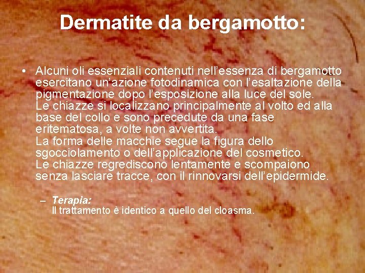 Dermatite da bergamotto: • Alcuni oli essenziali contenuti nell’essenza di bergamotto esercitano un’azione fotodinamica