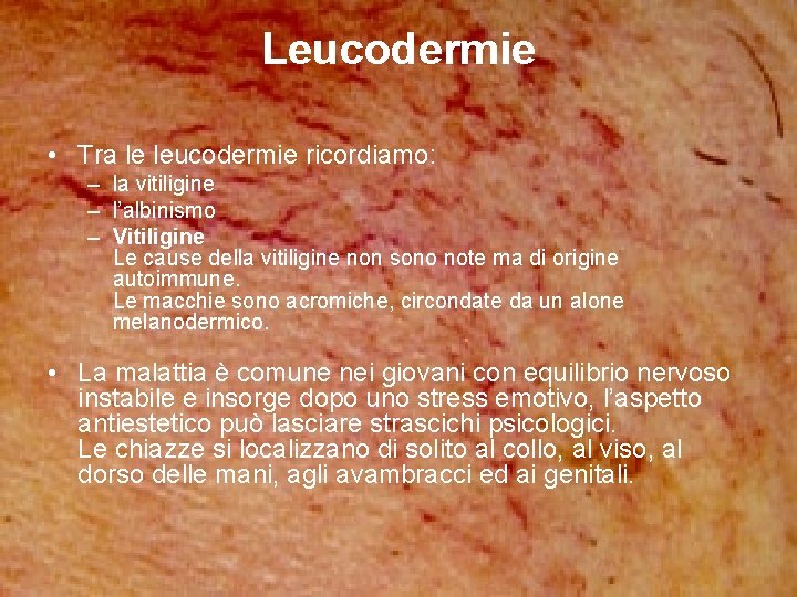 Leucodermie • Tra le leucodermie ricordiamo: – la vitiligine – l’albinismo – Vitiligine Le