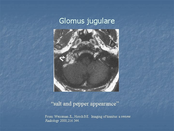 Glomus jugulare “salt and pepper appearance” From: Weissman JL, Hirsch BE. Imaging of tinnitus: