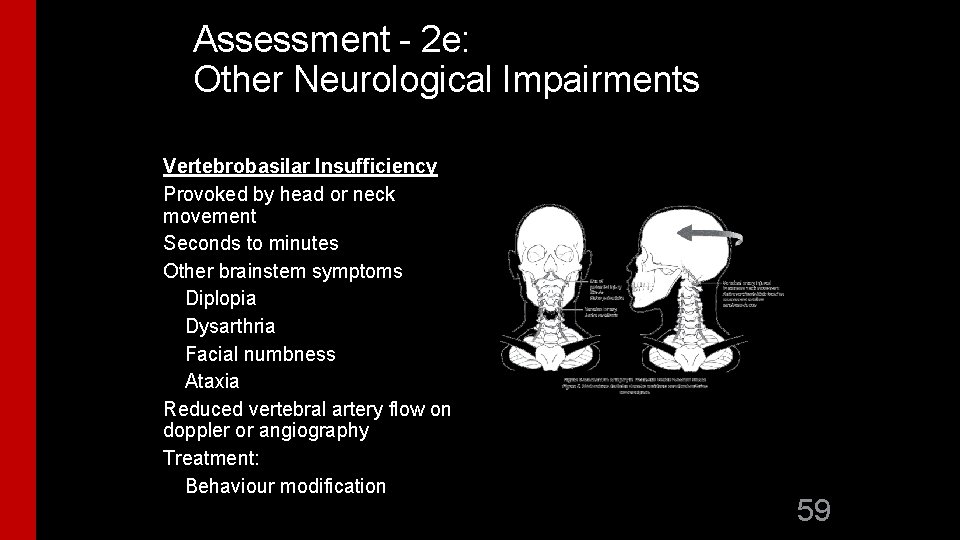 Assessment - 2 e: Other Neurological Impairments Vertebrobasilar Insufficiency Provoked by head or neck