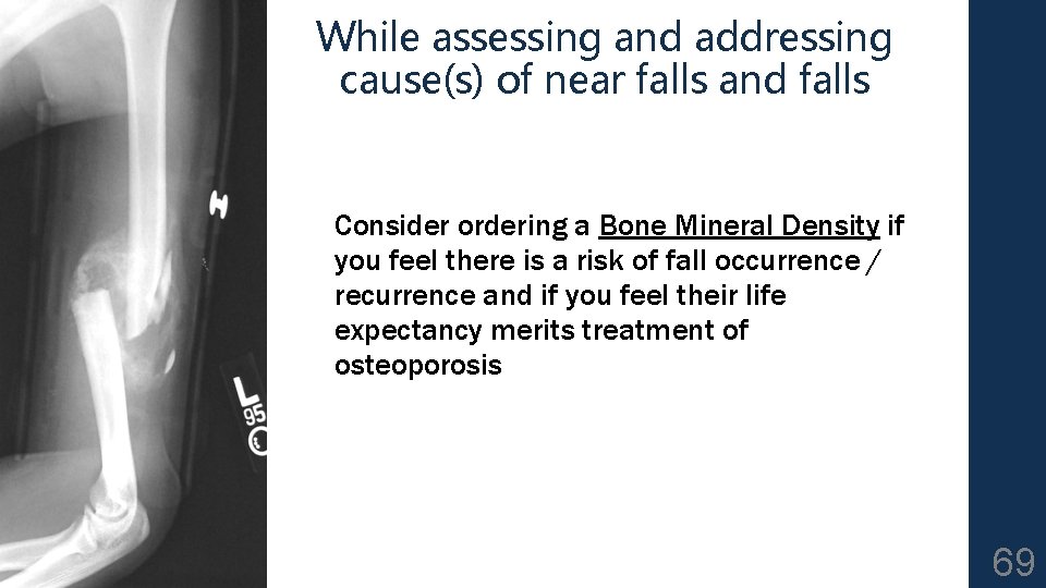 While assessing and addressing cause(s) of near falls and falls Consider ordering a Bone