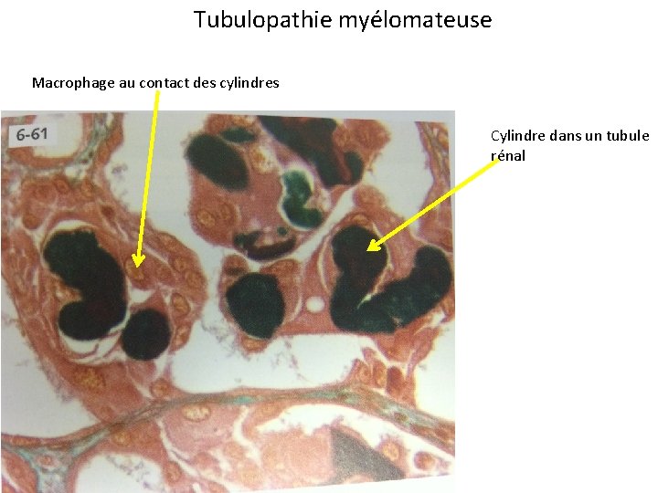 Tubulopathie myélomateuse Macrophage au contact des cylindres Cylindre dans un tubule rénal 