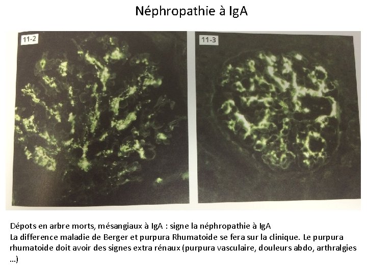 Néphropathie à Ig. A Dépots en arbre morts, mésangiaux à Ig. A : signe