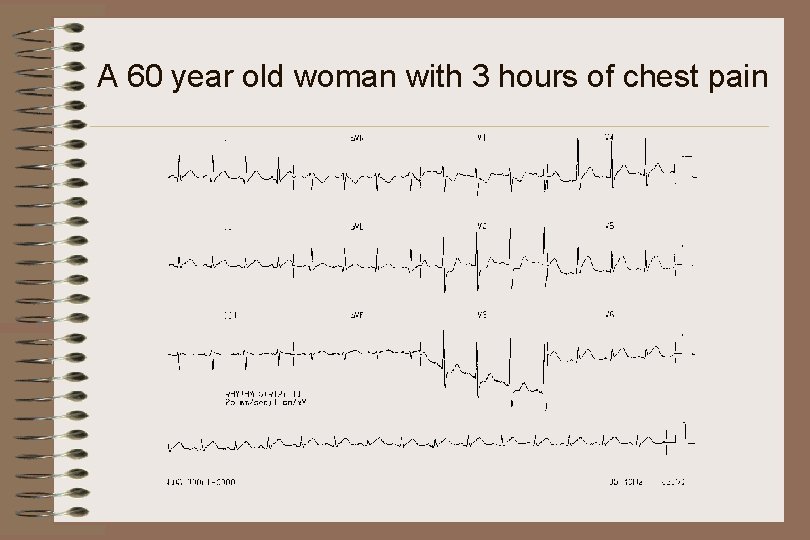 A 60 year old woman with 3 hours of chest pain 