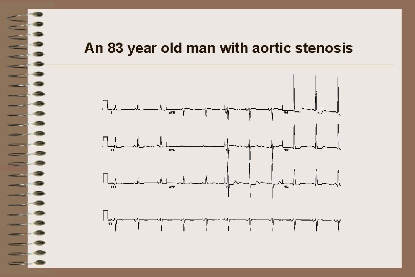 An 83 year old man with aortic stenosis 