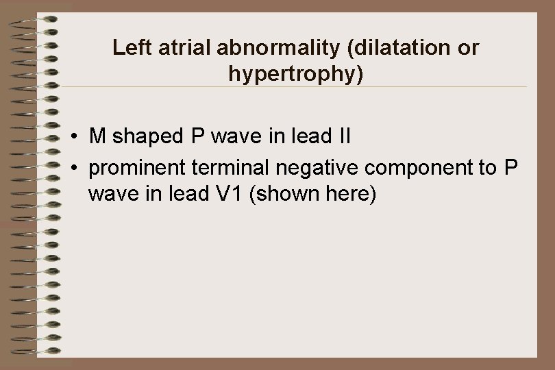 Left atrial abnormality (dilatation or hypertrophy) • M shaped P wave in lead II
