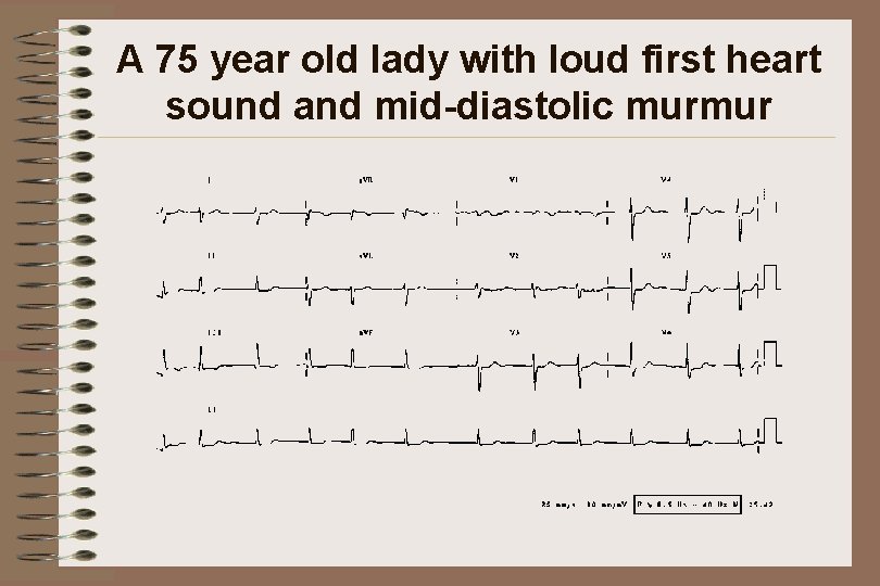 A 75 year old lady with loud first heart sound and mid-diastolic murmur 