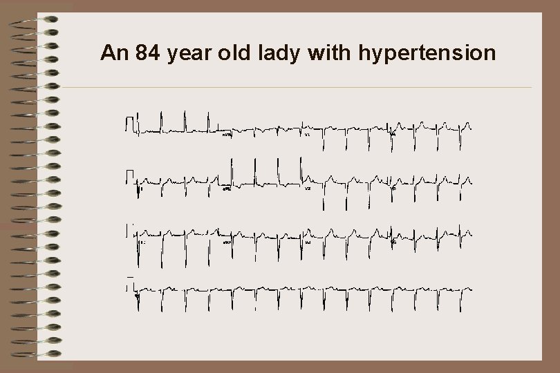 An 84 year old lady with hypertension 