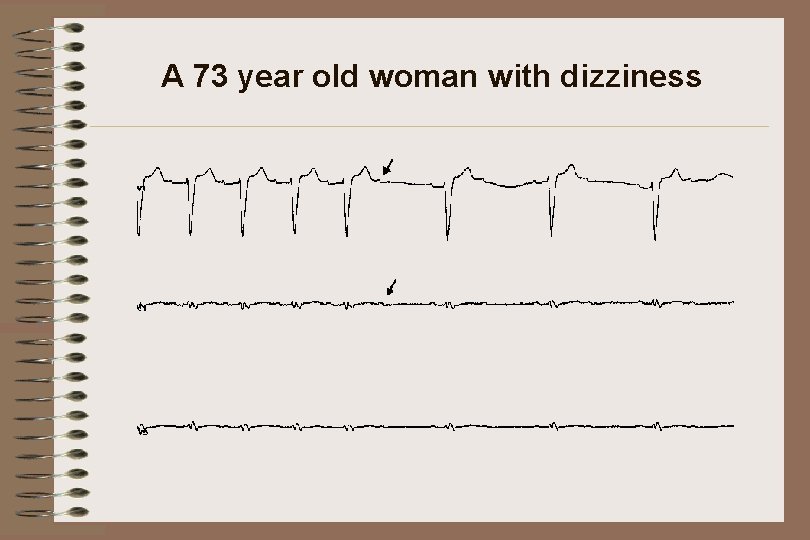 A 73 year old woman with dizziness 