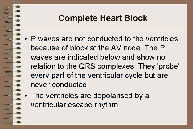 Complete Heart Block • P waves are not conducted to the ventricles because of